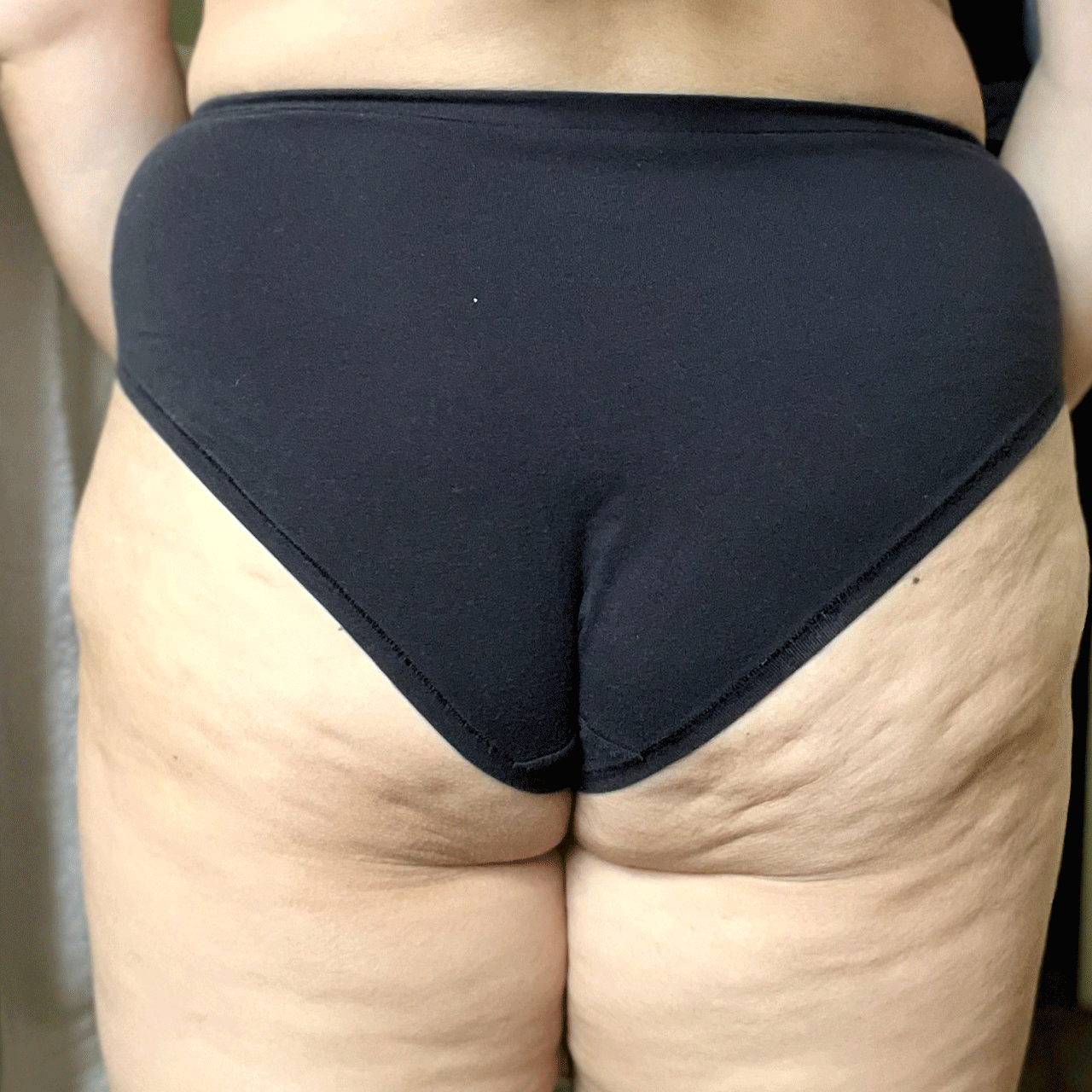 Before and After B-Tight Booty Mask